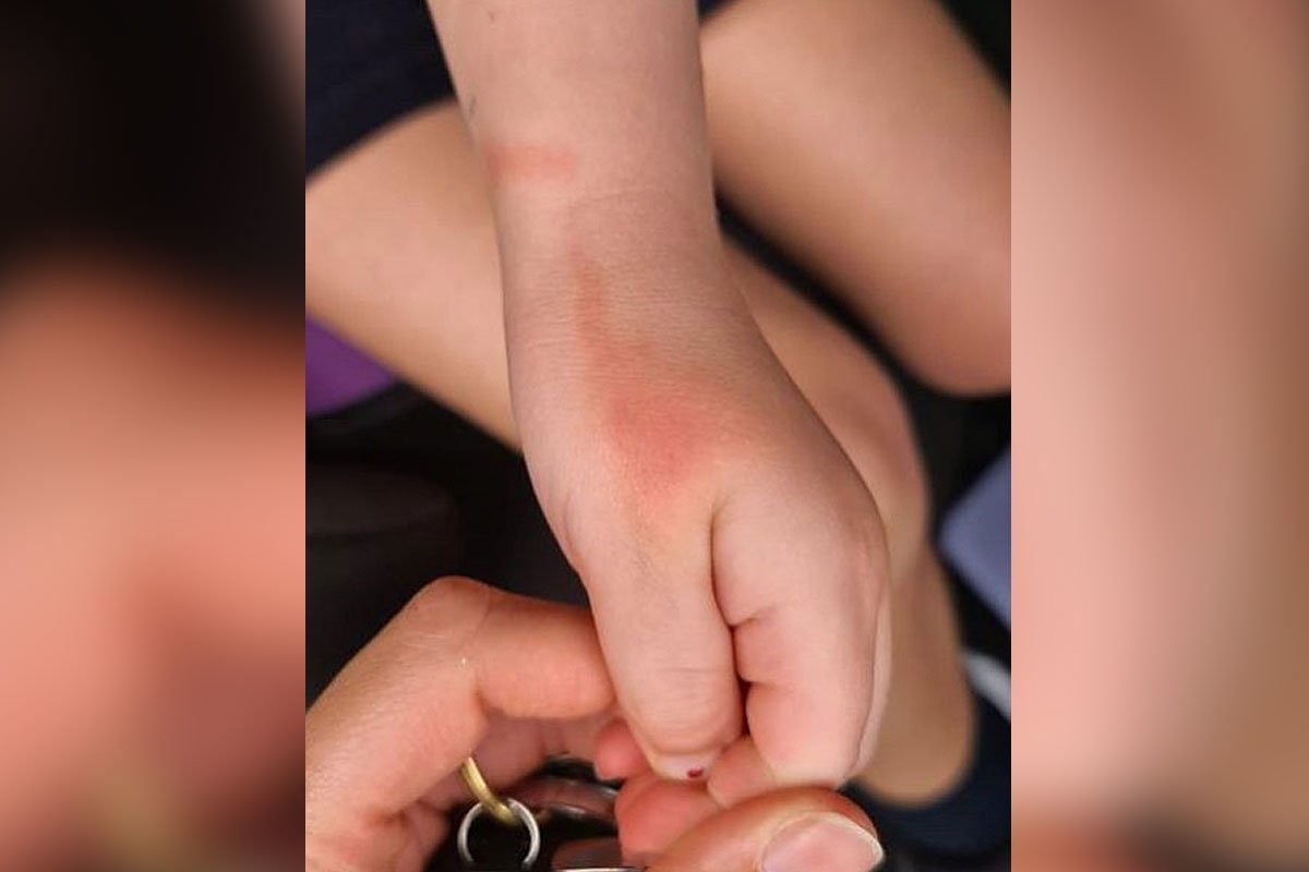 Мать заметила красные полосы на руке дочери и выяснила, что это симптом опасного заболевания